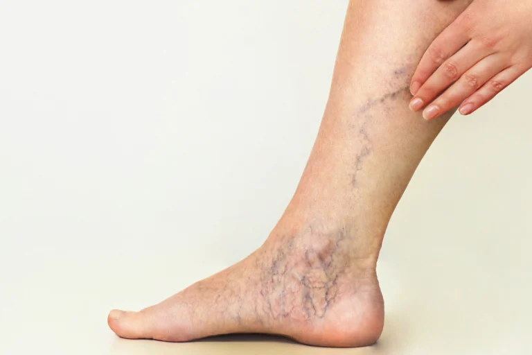 What are Important Tips to Manage Spider Veins? 